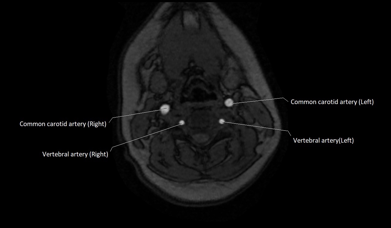Carotid artery anatomy axial 3T image 31.jpg